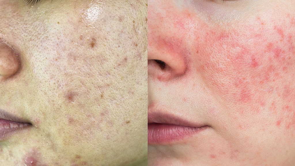 Should I stop using a product of my skin is purging