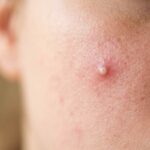 When To Apply Mighty Patch Hero Cosmetics Acne Patches
