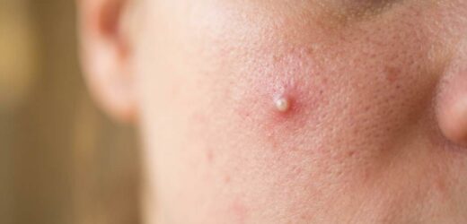 Woman applying Mighty Patch acne patch to a clean dry pimple
