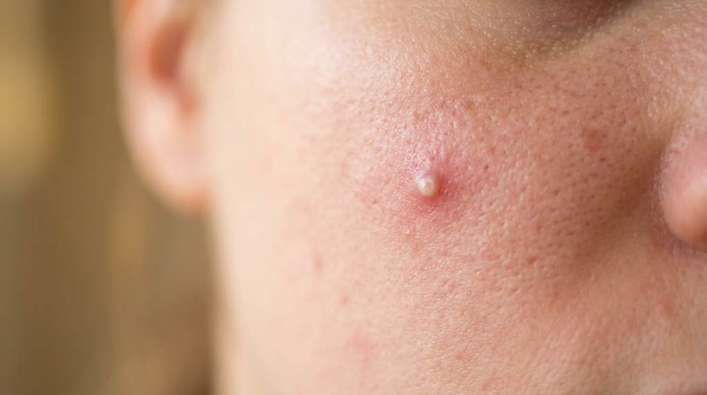 Woman applying Mighty Patch acne patch to a clean dry pimple